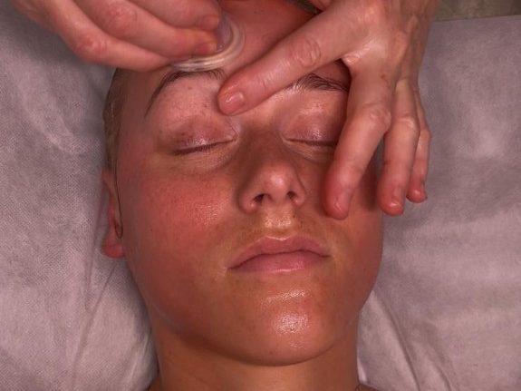 Transformational Cupping